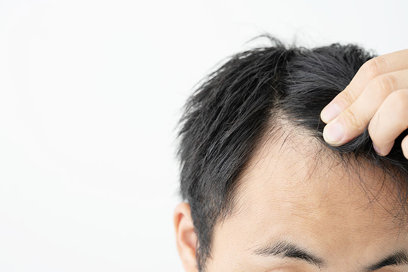 AGA（Androgenetic Alopecia: 男性型脱毛症）
